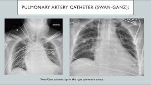 Swan Ganz Catheter