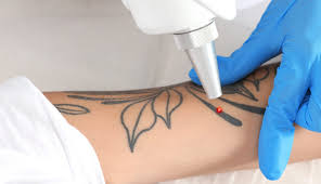 Tattoo Removal