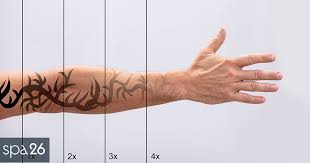 how much does tattoo removal cost